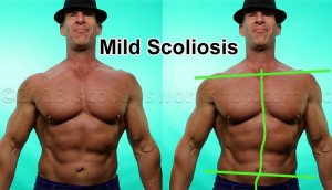 scoliosis