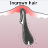 Ingrown Hair