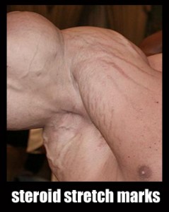 steroid-stretch-marks