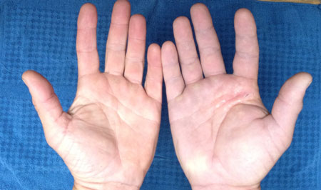 hand-injury-24rrs-later-bottom