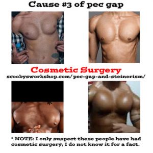 Cause-3-of-pec-gap-cosmetic-surgery