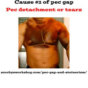 cause-2-of-pec-gap-muscle-tears